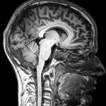 Beyin-MRI