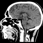 CT_of_a_normal_brain_(thumbnail)